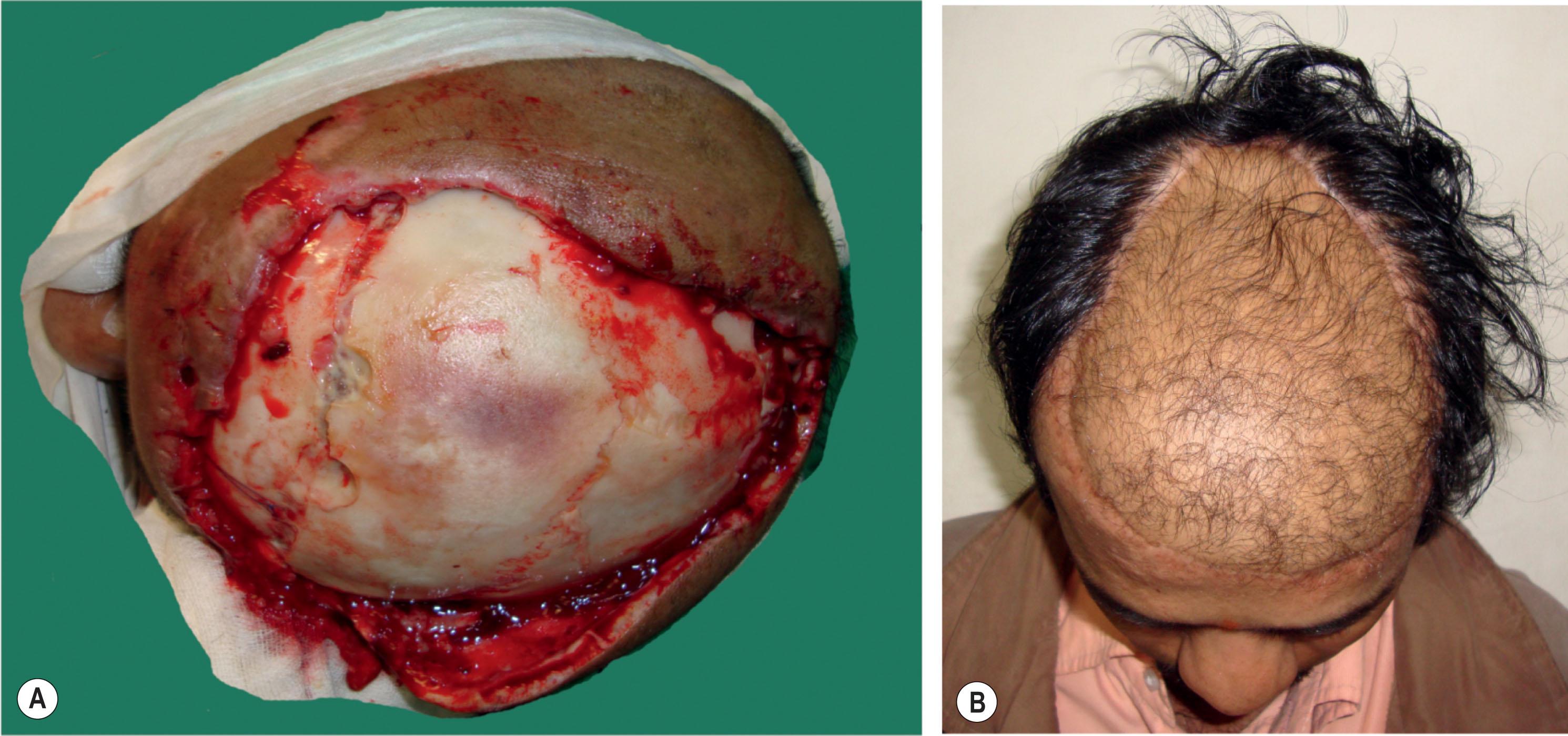 Figure 20.5, (A) Full-thickness electric injury with eschar on scalp. He had a subdural hematoma which was evacuated by craniotomy at another hospital, and ten days later the patient presented to us with dead necrotic scalp and for management of burn. (B) One year postoperative after resurfacing with anterolateral thigh (ALT) flap.