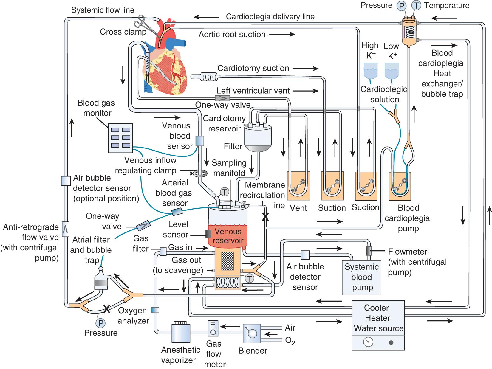 Fig. 144.2, Cardiopulmonary bypass circuit.