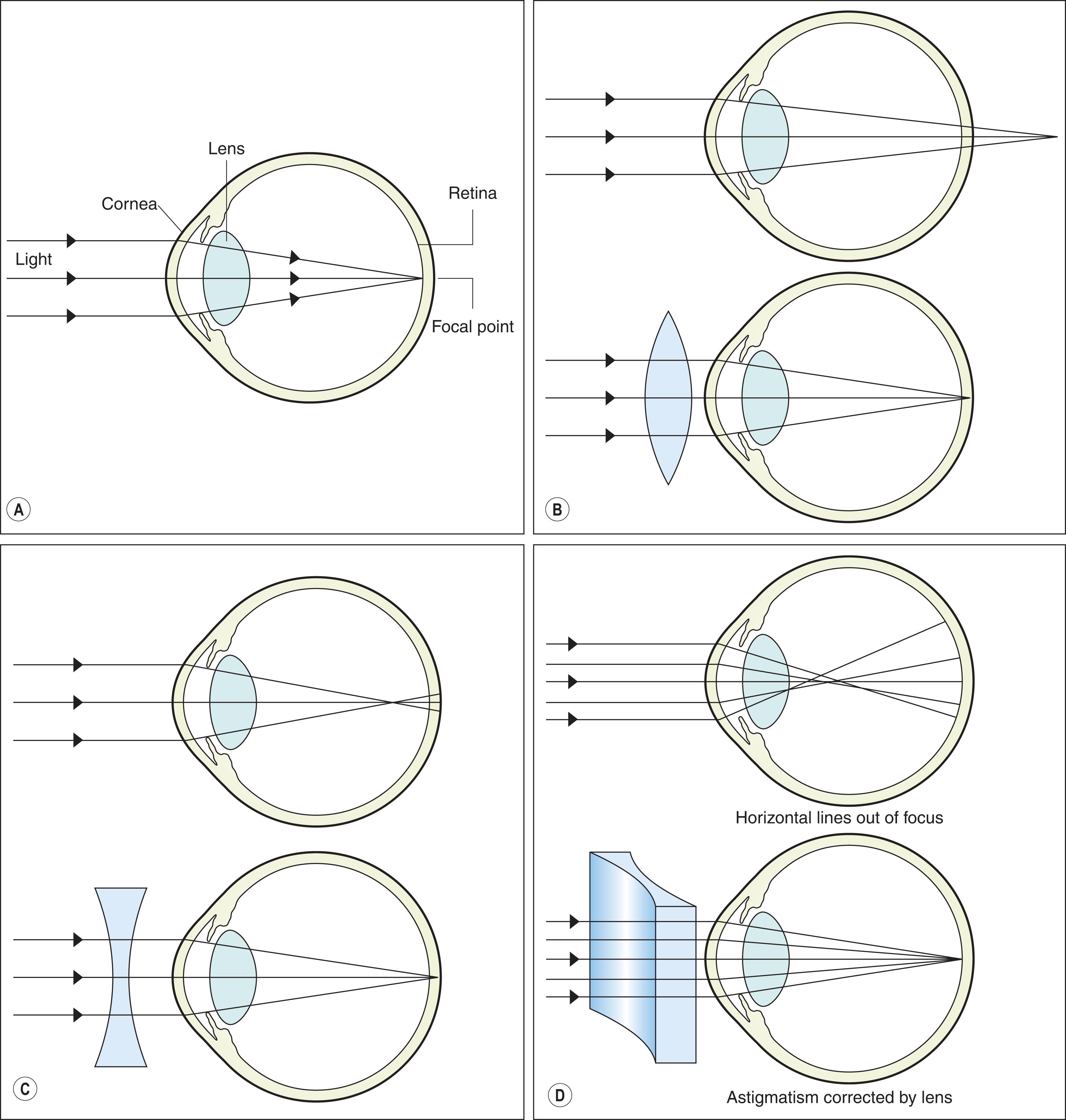 Fig. 6.1, (A) In emmetropia, the focusing power of the lens and cornea are exactly balanced by the length of the eye so that the light emanating from a distant object forms a perfectly focused image on the plane of the retina. (B) Hyperopia occurs when the focusing power of the eye is too weak, and/or the length of the eye is too short, such that the light rays focus behind the retina. A biconvex lens can be used to bring the image into focus. (C) Myopia occurs when the focusing power of the eye is too strong, and/or the length of the eye is too long, such that the light rays focus in front of the retina. A biconcave lens can be used to bring the image into focus. (D) With astigmatism there is a difference in power of the two principal meridians of the eye due to a toric curvature of the cornea and/or lens resulting in an inability to bring light into a point of focus on the retina. A toric lens brings both meridians into focus.