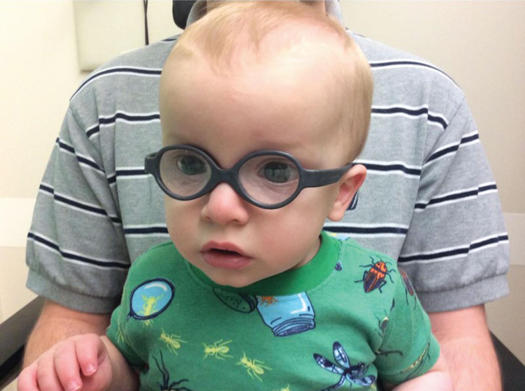 Fig. 6.2, This infant was seen at 2.5 months of age for parental concerns about poor visual interest. Hyperopia of 6 D was detected. Parents were reassured but returned when the child was 4 months old for similar concerns. Dynamic retinoscopy revealed 4 D of accommodative lag. Spectacles were prescribed. The parents noted immediate improvement in the child's visual interest and development with the +6 D spectacles.