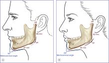 Fig. 12.2, Normal values for mentocervical angle (in degrees), height of the mandible ramus (in millimeters; go–cdl), and depth of the lower face (in millimeters; go–gn) in white North Americans: ( A ) young adult men and ( B ) young adult women. 1 The menton (or gnathion; gn) is the lowest median landmark on the lower border of the mandible. It is identified by palpation and is identical to the bony gnathion. The gonion (go) is the most lateral point of the mandibular angle close to the bony gonion. The mentocervical angle is formed by the upper contour of the chin and the surface beneath the mandible.