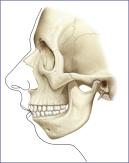 Fig. 12.3, Soft tissue contour and skeletal configuration of a patient with mandibular deficiency and corrected occlusion. Note the obtuse mandibular and mentocervical angles with steep mandibular plane.