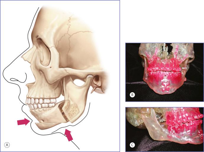 Fig. 12.4, Illustration (A) showing skeletal contour after sagittal split osteotomy and advancement of the distal segment, as well as sliding advancement genioplasty of the deficient mandible. Note that there is an indentation along the mandibular border at the sites of osteotomy and advancement. Acrylic models ( B , C ) obtained from CT scan data of a patient who had undergone sagittal split and horizontal maxillary osteotomies. Note the contour irregularities along the mandibular border at the sites of mandibular osteotomies. Note also the asymmetries in the posterior segment position. These will lead to discrepancies in lower face width and height.