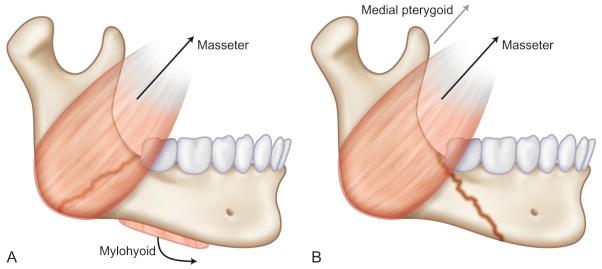 Fig. 1.14.4, (A) Horizontally unfavorable fracture; (B) horizontally favorable fracture.