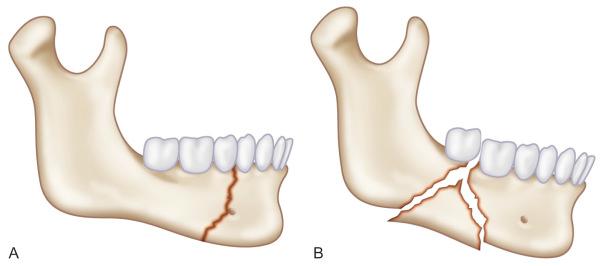 Fig. 1.14.8, (A) Body of the mandible fracture; (B) comminuted body of the mandible fracture.