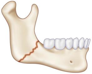 Fig. 1.14.9, Angle of the mandible fracture.