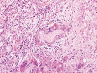 Figure 5.1, Pulse granuloma. Foreign body giant cells surround residual plant material (pulse) with associated fibrosis and chronic inflammation.
