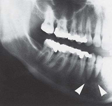 Figure 5.11, Radiograph illustrating mandibular benign osteoblastoma or cementoblastoma without calcification that was associated with periapical regions of permanent premolars (arrows) .