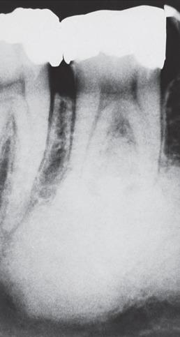 Figure 5.12, Typical radiographic appearance of cementoblastoma. A dense, homogeneous mass is seen in continuity with the tooth root.