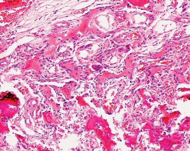 Figure 5.13, Cementoblastoma. Numerous neoformed osteoid trabeculae are lined by osteoblasts and separated by a highly vascularized matrix.