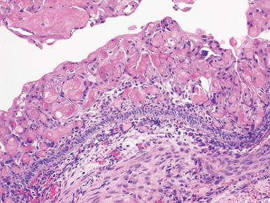 Figure 5.14, Calcifying cystic odontogenic tumor (CCOT). The epithelial cells resemble cystic ameloblastoma but the presence of ghost keratinocytes, some of which calcify, easily distinguish CCOT from ameloblastomas which lack them.