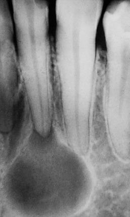 Figure 5.15, Periapical/radicular cyst demonstrating continuity with pulp canal of nonvital tooth.