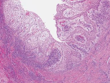 Figure 5.16, Periapical/radicular cyst. These are squamous lined cysts with marked inflammation and epithelial proliferation, the latter manifesting as elongated rete-like pegs.