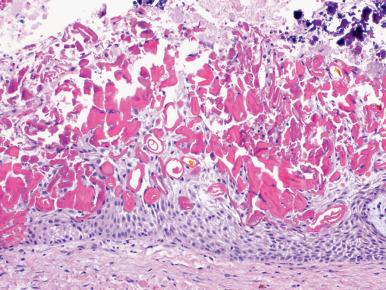 Figure 5.17, Periapical/radicular cyst with numerous intraepithelial eosinophilic Rushton bodies.