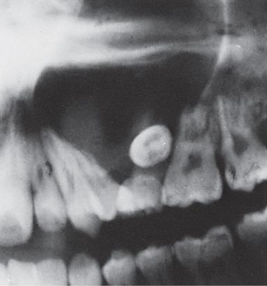 Figure 5.18, Radiograph demonstrating portion of maxillary odontogenic keratocyst in a 15-year-old with a 2-week history of facial swelling.