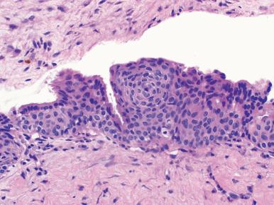 Figure 5.20, Glandular odontogenic cysts can be unilocular or multilocular. They are lined by squamoid epithelial cells with occasional thickened plaques. Other features include eosinophilic surface cells, mucous cells, and intraepithelial glandular lumens.