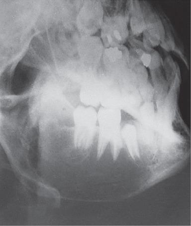 Figure 5.2, Simple bone cyst of mandible in an 11-year-old girl. Note thin shell of remaining bone at the inferior aspect of the mandible.