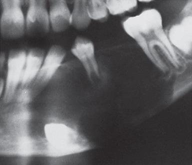 Figure 5.3, Radiographic appearance of recurrent central giant cell granuloma in a 10-year-old girl. The inferior border of mandible has been eroded and the involved teeth are displaced.