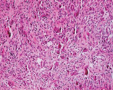 Figure 5.4, Central giant cell granuloma. Osteoclast-like giant cells are scattered within a fibroblastic matrix.