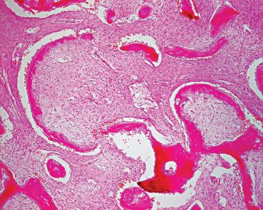 Figure 5.5, Fibrous dysplasia. Curvilinear bone trabeculae are surrounded by a dense fibrous stroma. Osteoclasts are lacking.