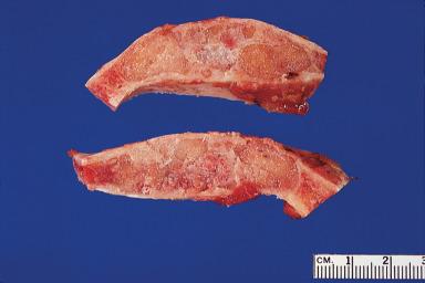 Figure 5.7, Gross appearance of ossifying fibroma. The lesion is hard, whitish, and well defined.