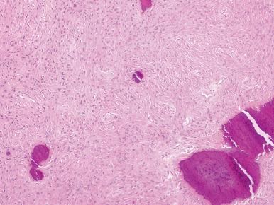 Figure 5.8, Conventional ossifying fibroma is less homogeneous compared to fibrous dysplasia and contains irregular globoid bone with a bland cellular spindled stroma.