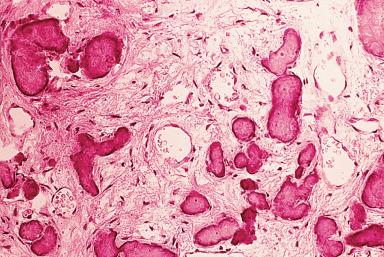 Figure 5.10, Periapical cemental dysplasia.