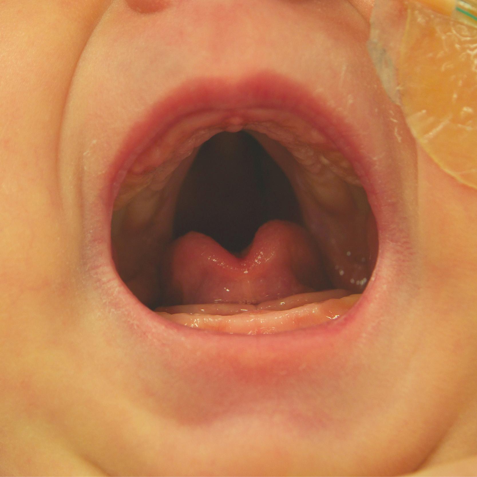 Fig. 202.1, Preoperative view of oral examination in an infant with Pierre Robin sequence. Microretrognathia, glossoptosis, and a wide Veau II cleft palate are noted.