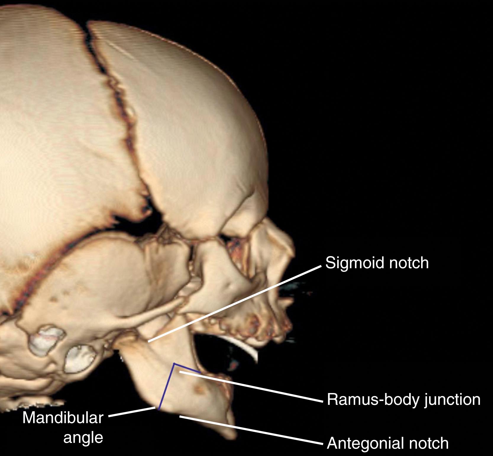 Fig. 202.2, Computed tomography scan of the mandible with 3D reconstruction showing key landmarks in white and planned “inverted-L” osteotomy in blue. This osteotomy position avoids the most posterior developing tooth bud, which is generally located in the position marked “Ramus-Body Junction.” Significant maxillary-mandibular discrepancy is noted.