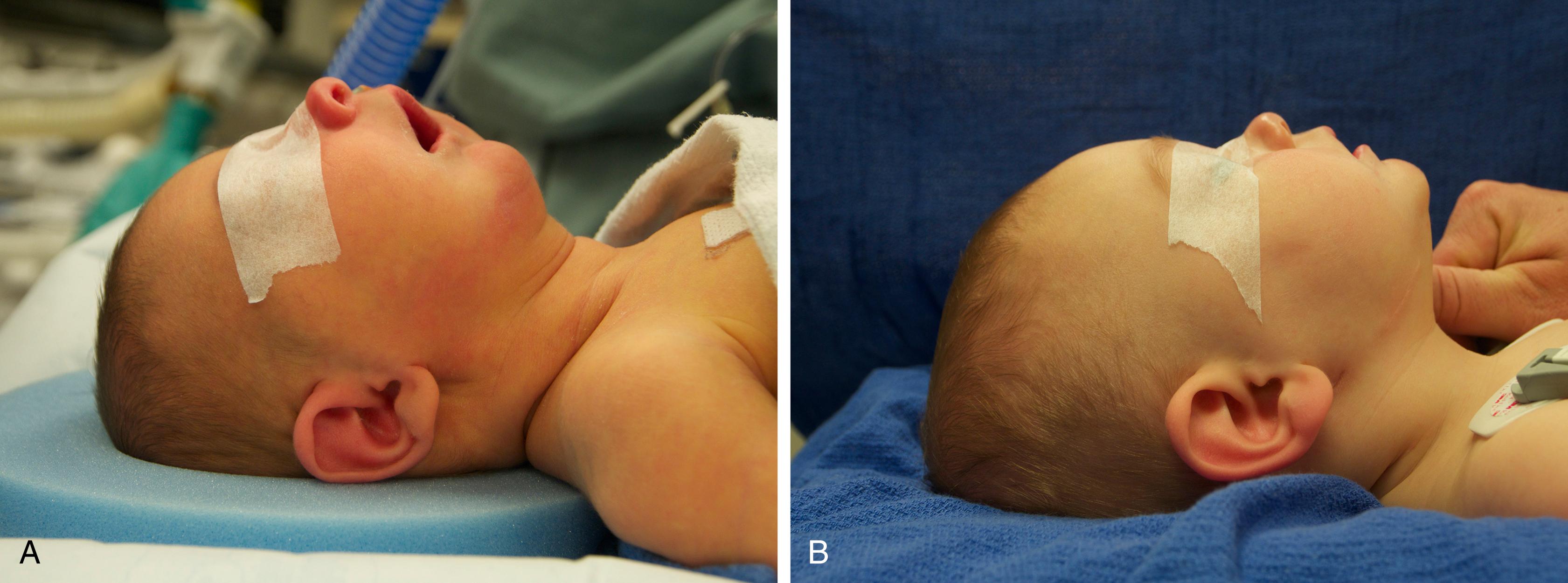 Fig. 202.3, A typical preoperative view showing marked microretrognathia (A) and a postoperative view of the same patient just prior to removal of distractor hardware (B) . The mandible is being gently guided into occlusion. Resolution of the class II occlusion has been achieved. Minimal scarring is noted from the incision and extension rod sites.