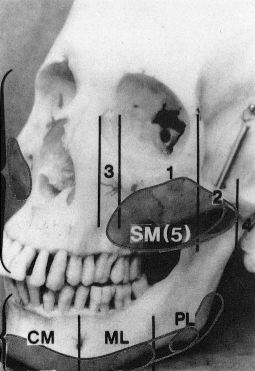 Figure 17-1, The mandible can be anatomically divided into three zones. The first zone extends from the mentum to mental foramen (CM-Zone 1). The midlateral zone is defined by a line extending from the mental formen posteriorly to the oblique line of the horizontal body of the mandible (ML-Zone 2). The third and last zone of the premandibular space ecompasses the posterior half of the horizontal body, including the angle of the mandible and the first 2 to 4 cm of the ascending ramus (PL-Zone 3).