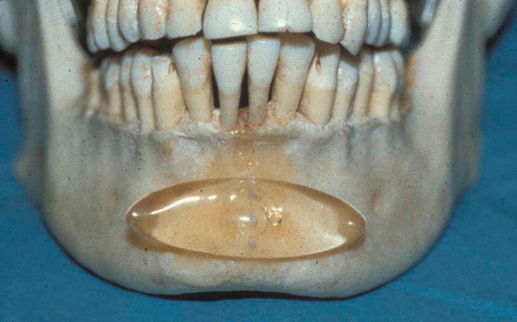 Figure 17-2, The traditional chin implants, as depicted in this photograph, were placed only wthin the central area (Zone 1) without lateral extension into the midlateral zones. These early implants were unidimensionally-designed utilizing a single vector.