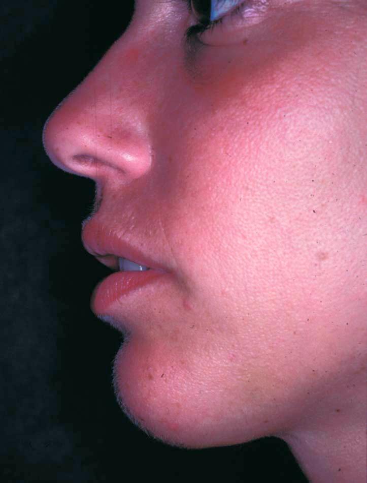 Figure 17-3, Traditional central implants placed in Zone 1 often created suboptimal results.
