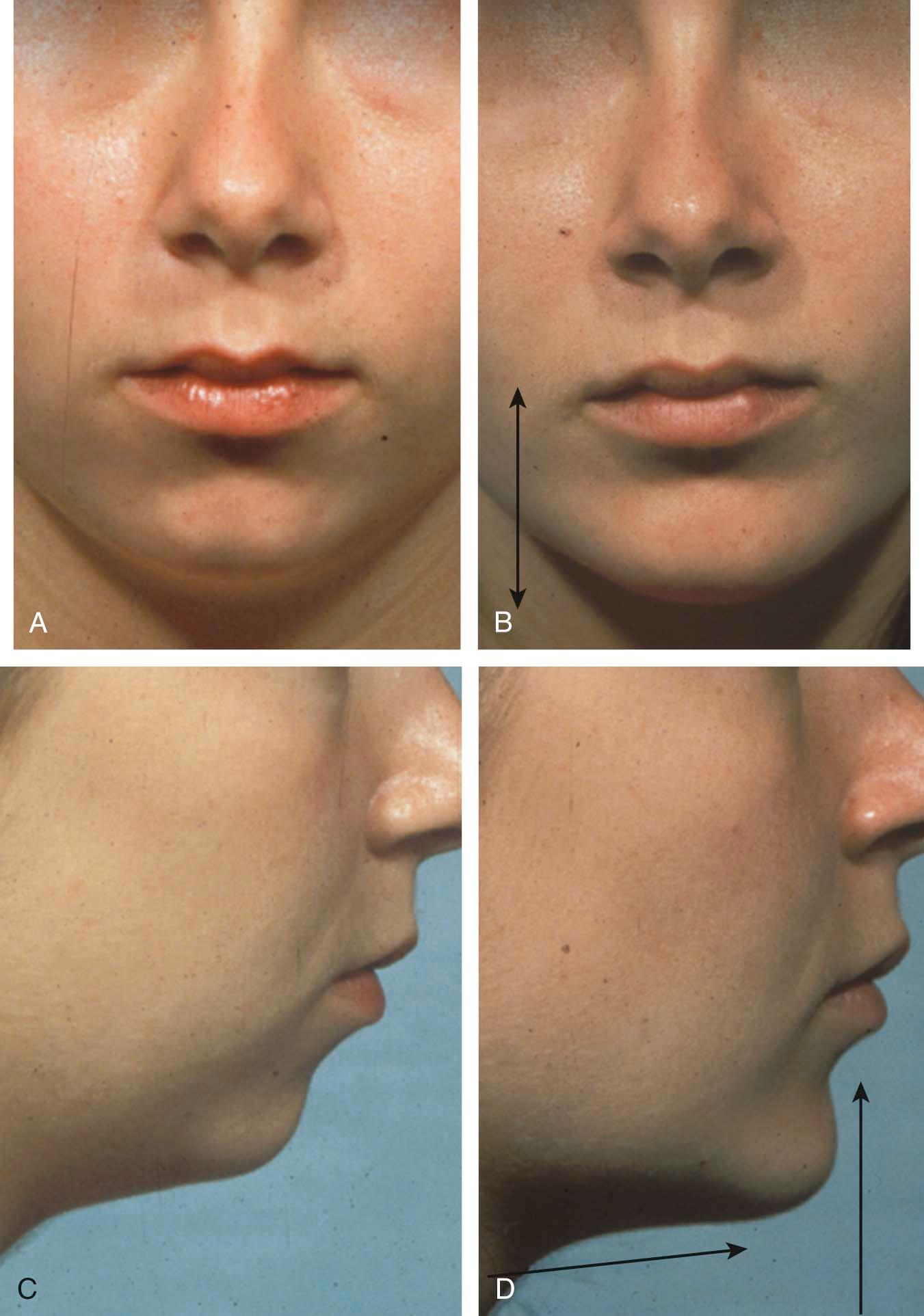 Figure 17-5, Placement of an implant that extends into at least 2 zones (central chin & midlateral) results in a natural widening of the anterior jawline as well as increasing the vertical dimenstion to the lower third of the face. A, C Pre-op; B, D Post-op photo after chin augmentation. The implant resides “low” on the mandible preserving a normal labiomental sulcus.