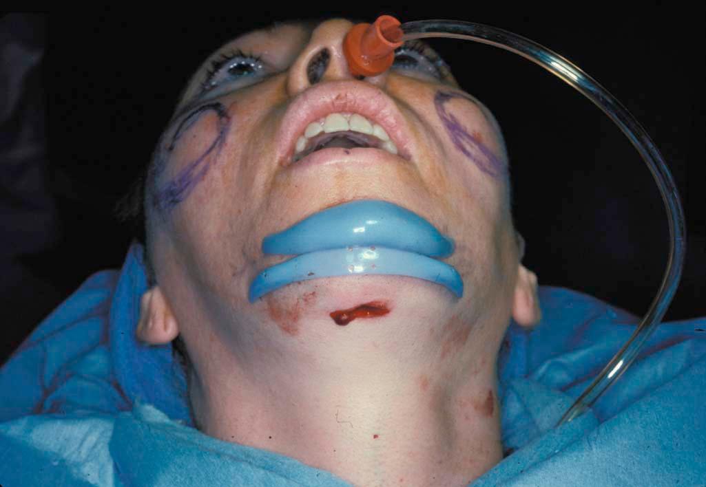 Figure 17-6, The prejowl and prejowl–chin implants along with other procedures such as liposuction and rhytidectomy address the structural elements of the lower face and the manifestations of aging.