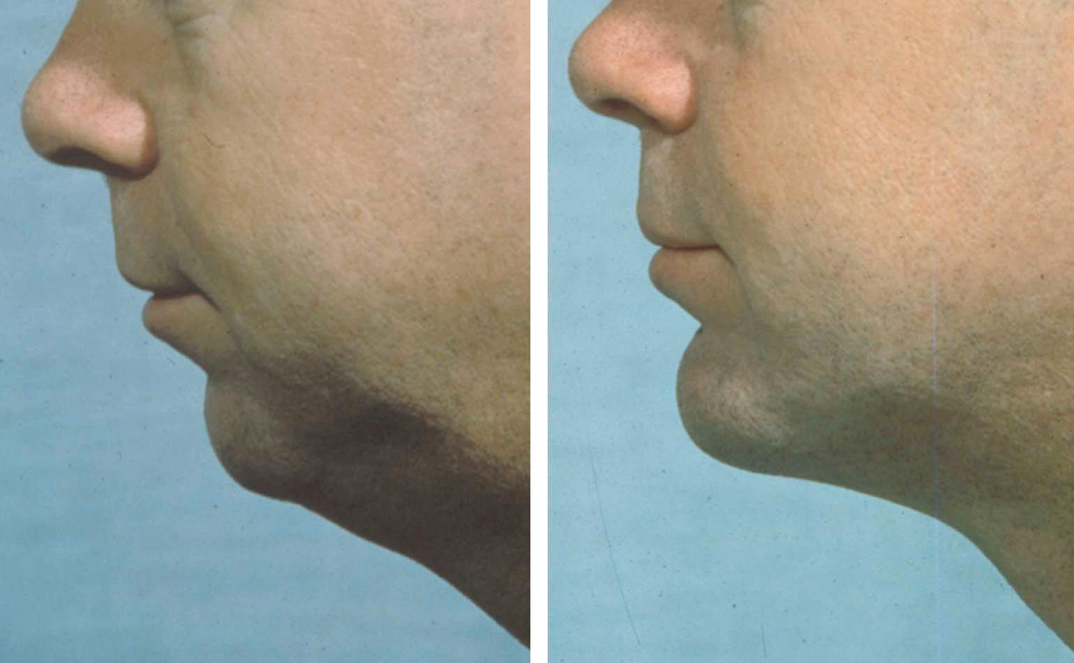 Figure 17-7, A, Pre-op; B, Post-op after chin augmentation and submental liposuction.