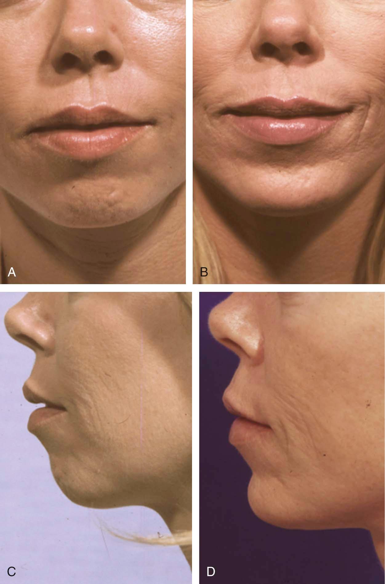 Figure 17-8, A, C, Pre-op; B, D, Post-op after chin augmentation.