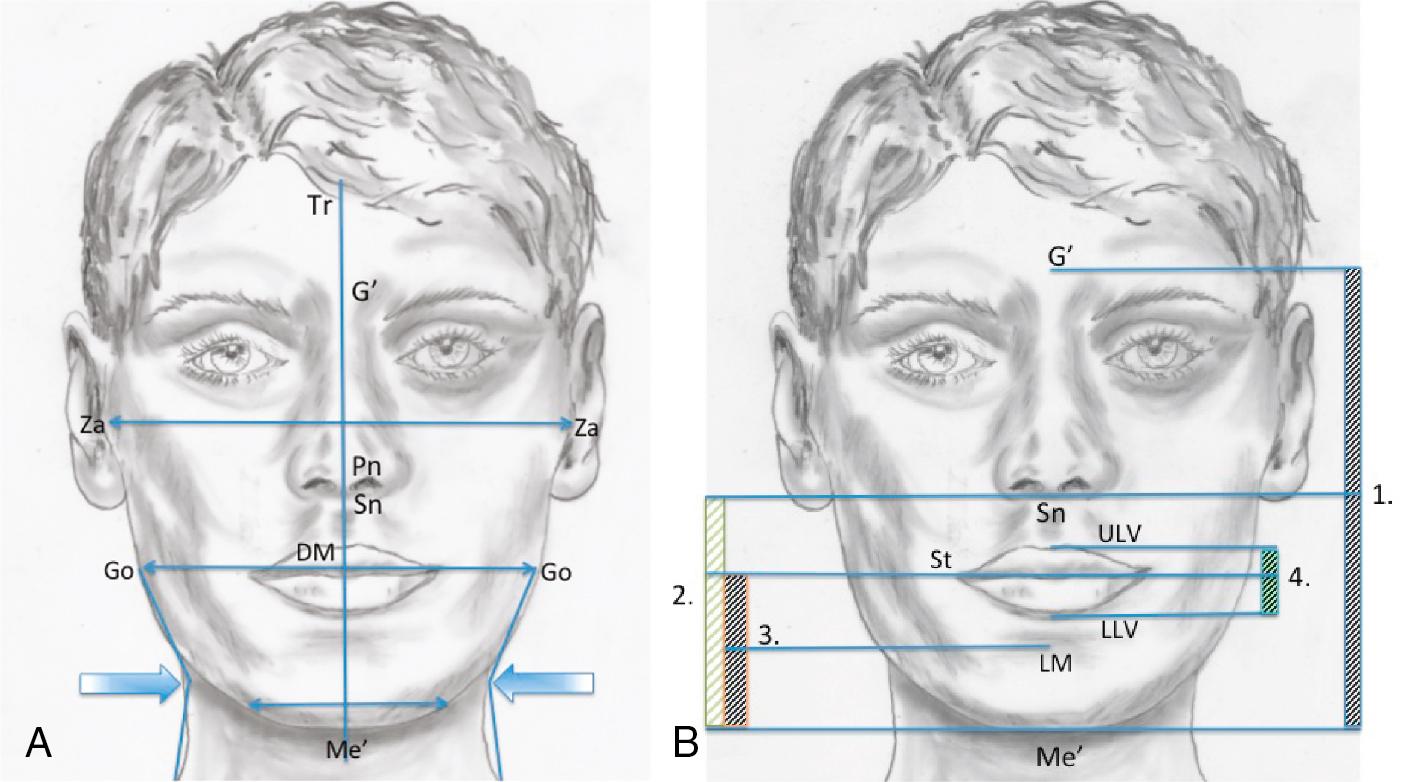 Fig. 21.1, (A) Facial form and transverse facial relationship. The facial height (Tr–Me’): bizygomatic width (Za–Za) should be 1.3:1 for females and 1.35:1 for males. The bigonial width (Go–Go) should be approximately 30% of the bizygomatic width. There should be an hourglass appearance between the neck and the lower border of the mandible ( arrows ). The symmetry of the face can be assessed by drawing a line connecting trichion (Tr), glabella (G’), pronasale (Pn), subnasale (Sn), dental midlines (DM), and menton (Me’). (B) Vertical facial relationships . ( 1 ) The middle third facial height (G’–Sn) and lower third facial heights (Sn–Me’) should be equal. ( 2 ) The lower facial height is further divided into an upper third (Sn–Sts) and lower two thirds (Sti–Me’). ( 3 ) The labiomental fold (LM) is deepest halfway between stomion (Sti) and menton (Me’). ( 4 ) The upper lip vermilion (ULV) should be 25% thinner than the lower lip vermilion (LLV).