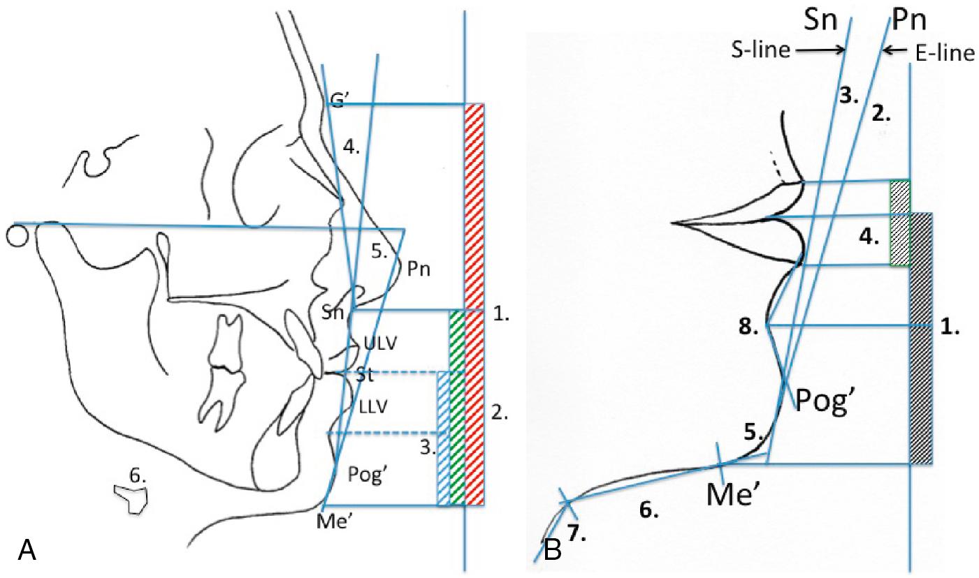 Fig. 21.2, (A) ( 1 ) The middle and lower third facial heights should be equal. ( 2 ) The lower facial third is divided into an upper third (Sn–St) and a lower two thirds (St–Me’). ( 3 ) The depth of the labiomental fold (LM) divides the lower two thirds in two equal halves. ( 4 ) The angle formed between the upper facial plane (G’–Sn) and lower facial plane (Sn–Pog) should be 13 ± 4 degrees for females and 11± 4 degrees for males. ( 5 ) The Merrifield Z-angle is formed between the Frankfurt horizontal and a line connecting Pog’ and the most protrusive point of the upper or lower lip. An angle of 80 ± 9 degrees is considered normal. ( 6 ) The hyoid cartilage should be situated ±20 mm below the lower border of the mandible at the level of the first molar. (B) ( 1 ) The chin (anterior mandibular) height (Sti–Me’) should be 44 ± 2 mm for males and 40 ± 2 mm for females. ( 2 ) The E-line is drawn from pronasale (Pn) to pogonion (Pog’), and the lower lip should be 2 mm behind and the upper lip 4 mm behind the line. ( 3 ) The S-line is formed by connecting Pog’ and a point halfway between Sn and Pn. The lower lip and the upper lip should touch the line. ( 4 ) The upper lip vermilion (ULV) should be 25% thinner than the lower lip vermilion (LLV). ( 5 ) Lower lip–chin–submental angle should be ±121 degrees for males and ± 126 degrees for females. ( 6 ) Chin–throat length: This measurement is made from the submental neck point to soft tissue menton (Me’) and should be 42 ± 6 mm. ( 7 ) The chin–throat angle (cervicomental angle) is formed by a submental tangent and a line tangent to the neck (±126 degrees). ( 8 ) The labiomental angle is formed by the intersection of the lower lip and the chin. It is actually a gentle curve and should be 120 ± 10 degrees.