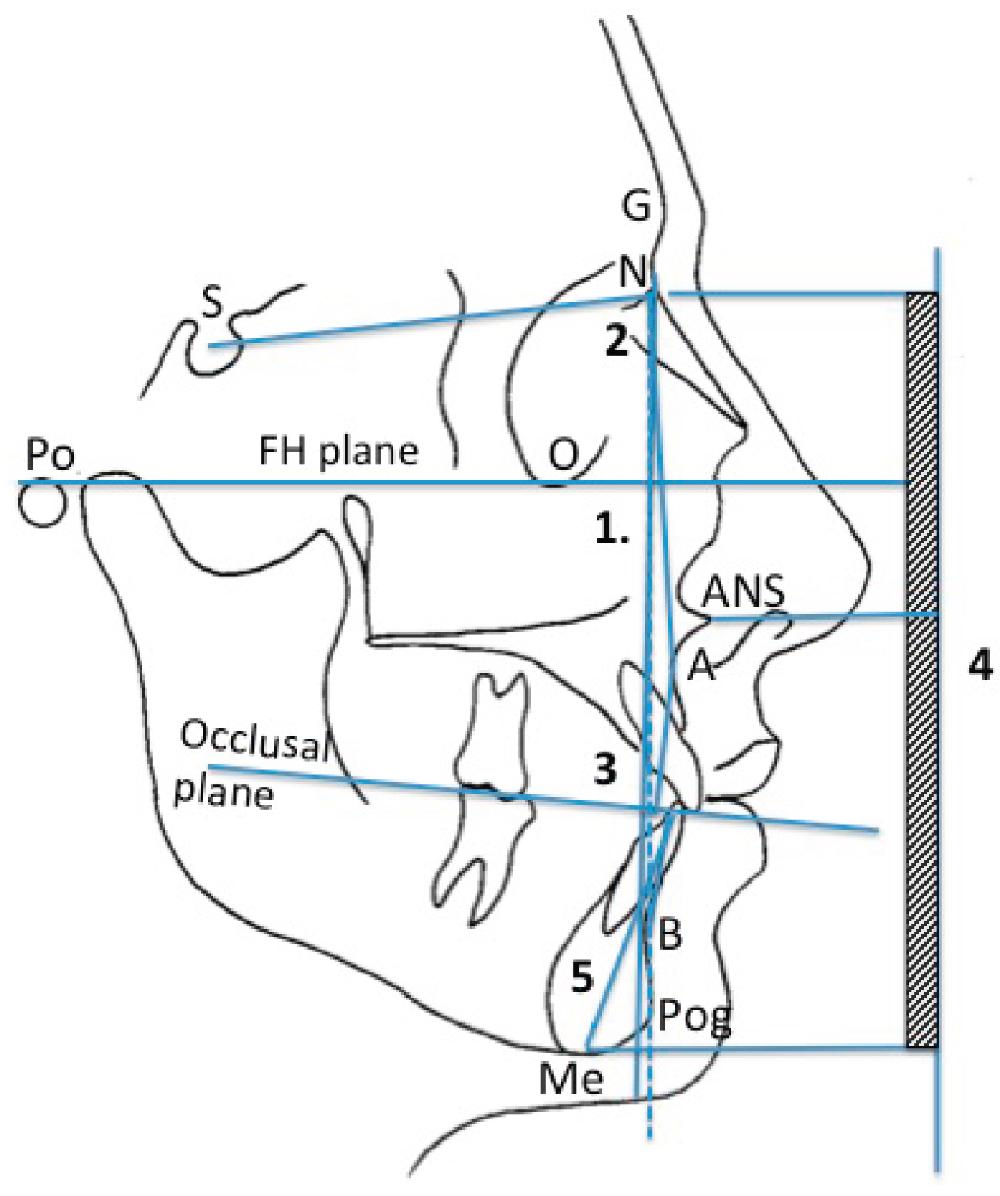 Fig. 21.3, ( 1 ) The facial angle. The angle is measured as the inferior inside angle between the Frankfurt horizontal (FH) plane and the facial line (N–Pog) ( dotted ). Mean 82 to 95 degrees. ( 2 ) The Steiner analysis for mandibular and maxillary anteroposterior relations to the anterior cranial base (S–N). Sella–nasion–A-point (SNA) is 82 degrees and sella–nasion–B-point (SNB) 80 degrees. The inter relationship between maxilla and mandibular is indicated by the ANB (A point, nasion, B-point) angle (82 degrees). ( 3 ) The Wits appraisal is an indication of the anteroposterior relationship between the maxilla and the mandible in relation to the occlusal plane (OP). The mean in males for is BO to be 1 mm ahead of AO and in females BO and AO to coincide. ( 4 ) The skeletal relationship between the middle and lower facial heights (G–ANS: ANS–Me = 5:6). ( 5 ) The anterior mandibular height should be 44 ± 2 mm for males and 40 ± 2 mm for females.