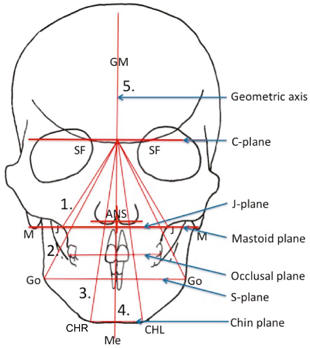Fig. 21.4, By connecting the C-point to the J-plane, the S-plane and the Chin–plane three triangles are constructed: The ( 1 ) maxillary triangle, ( 2 ) mandibular triangle, and ( 3 ) chin triangle. ( 4 ) The dental and chin midlines are evaluated in relation to the geometric midline (GM). ANS , Anterior nasal spine; CHL and CHR , the inferior border of the chin at maximum bone contact through Me. Go , gonion; M , mastoid point.