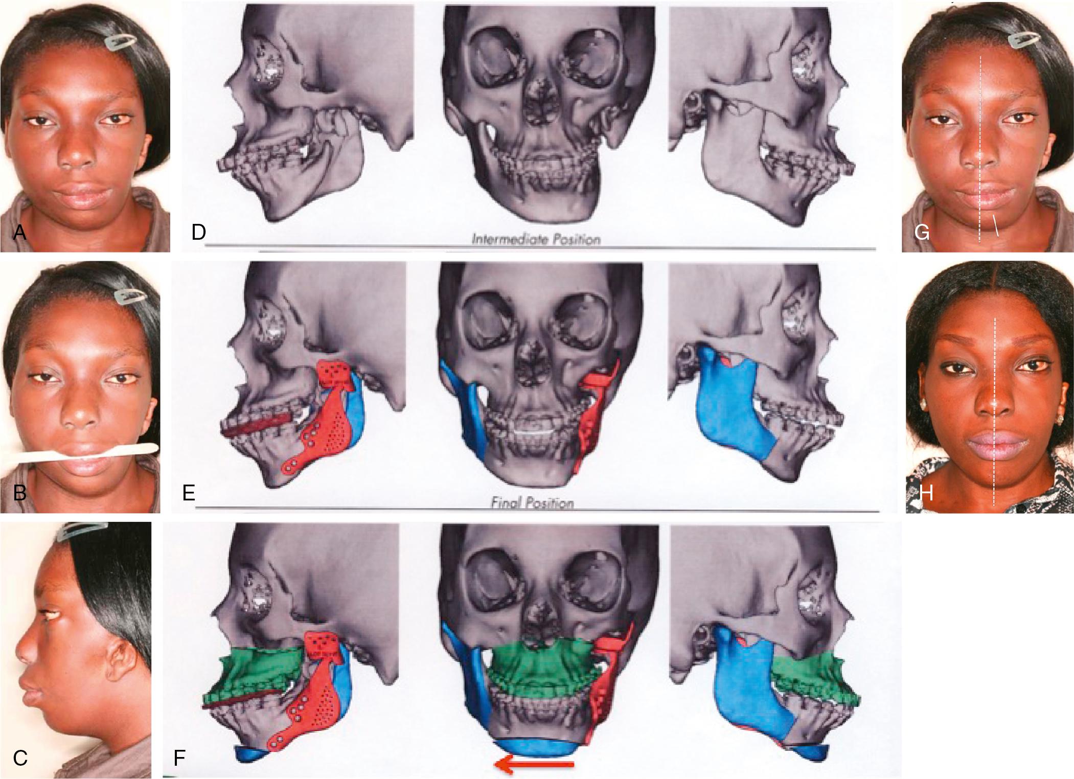 Fig. 21.5, Case 1. A patient with facial asymmetry as a result of hemifacial microsomia. (A) Frontal view: The severe mandibular and chin asymmetry is evident. The patient also has microtia and masseter and temporal muscle hypoplasia due to the congenital absence of her left condyle and mandibular ramus. (B) The transverse occlusal cant of the maxilla is demonstrated by the interocclusal tongue spatula. (C) Left profile view: The mandible and chin is anteroposteriorly deficient while her lip prominence is caused by bimaxillary protrusion. (D) The three-dimensional (3D) digital image demonstrates the severe skeletal deformity as well as the extent of the congenital agenesis of the left ramus and condyle is demonstrated. (E) An intermediate 3D visual treatment planning involving mandibular surgery first. The left temporomandibular joint and ramus will be reconstructed with a patient matched alloplastic implant (*Zimmer Biomet), whereas the right side will be advanced by means of a sagittal split mandibular ramus osteotomy. (F) The maxillary occlusal cant is corrected by means of a LeFort I osteotomy, whereas final symmetry is achieved by sliding the chin to the right ( arrow ). (G) Pretreatment frontal view. (H) Postorthognathic surgery frontal view.