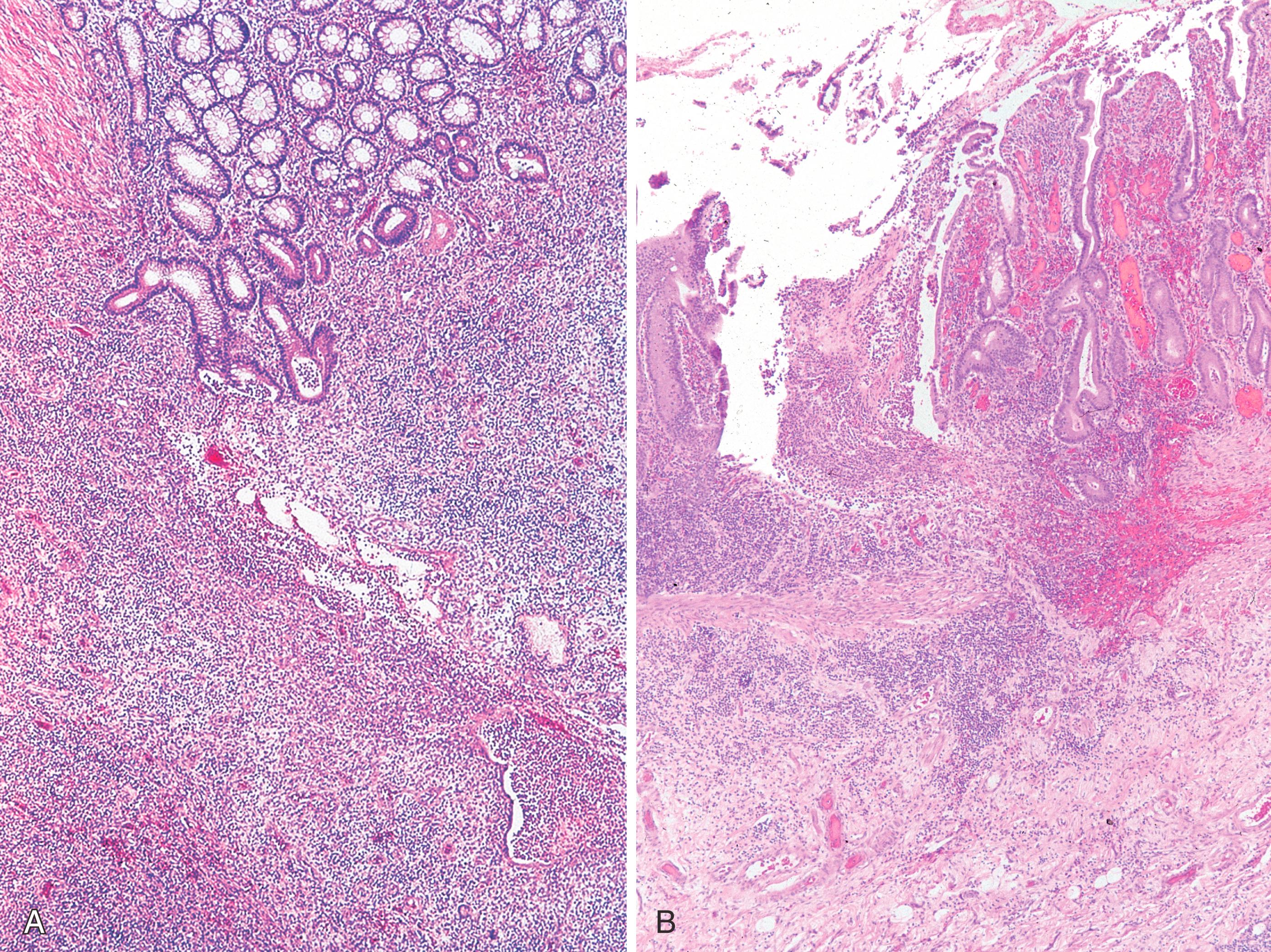 FIGURE 5.1, A–B, A chronic inflammatory disorder with fissuring necrosis and small-intestinal ulcers resembling Crohn’s disease occurs in some patients with X-linked agammaglobulinemia. Granulomas are typically absent (H&E stain).