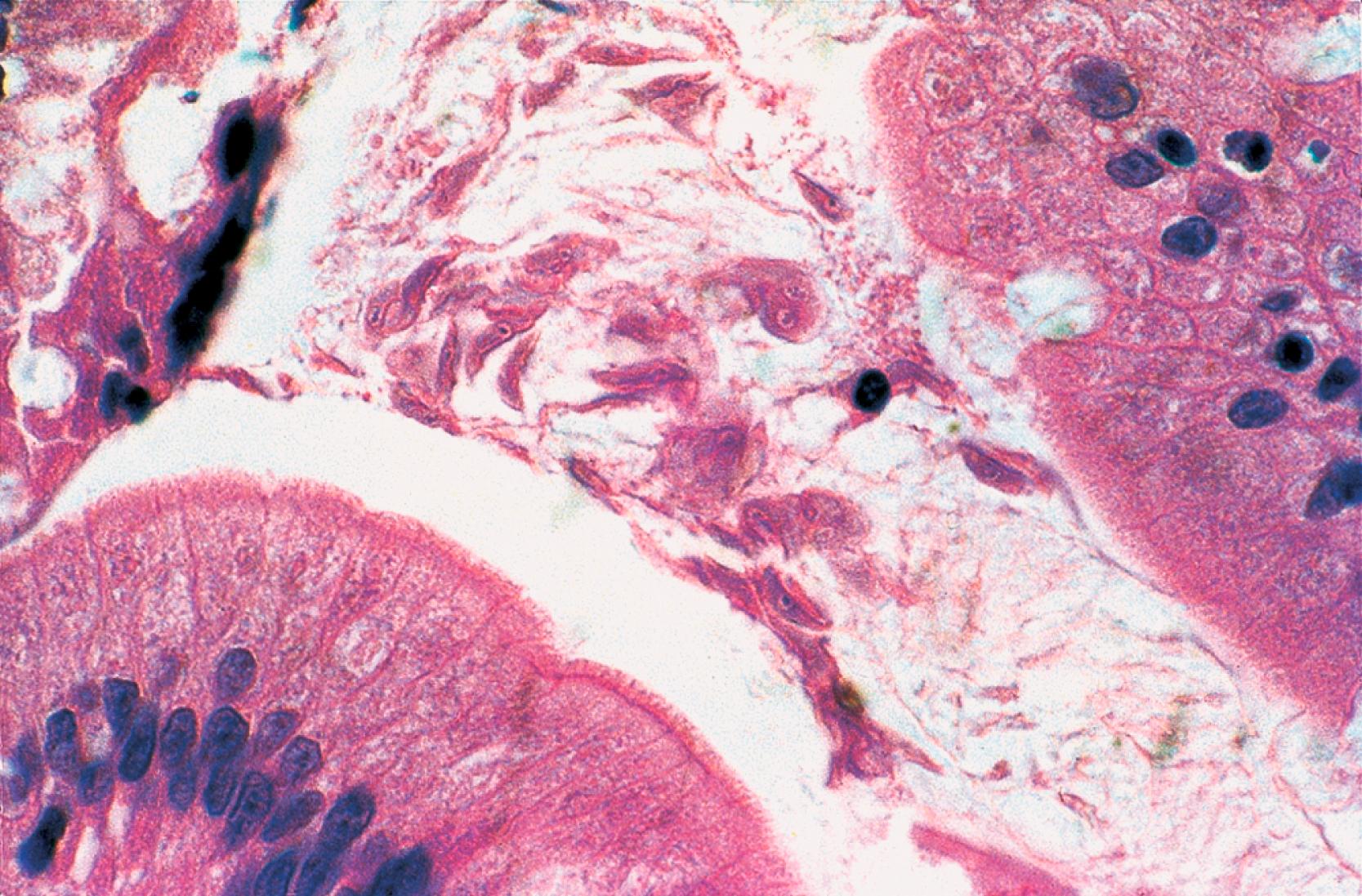 FIGURE 5.2, Giardiasis. Numerous trophozoites in varying orientations are closely associated with the surface of this small bowel biopsy specimen from a patient with common variable immunodeficiency. The underlying epithelium is normal (H&E stain).