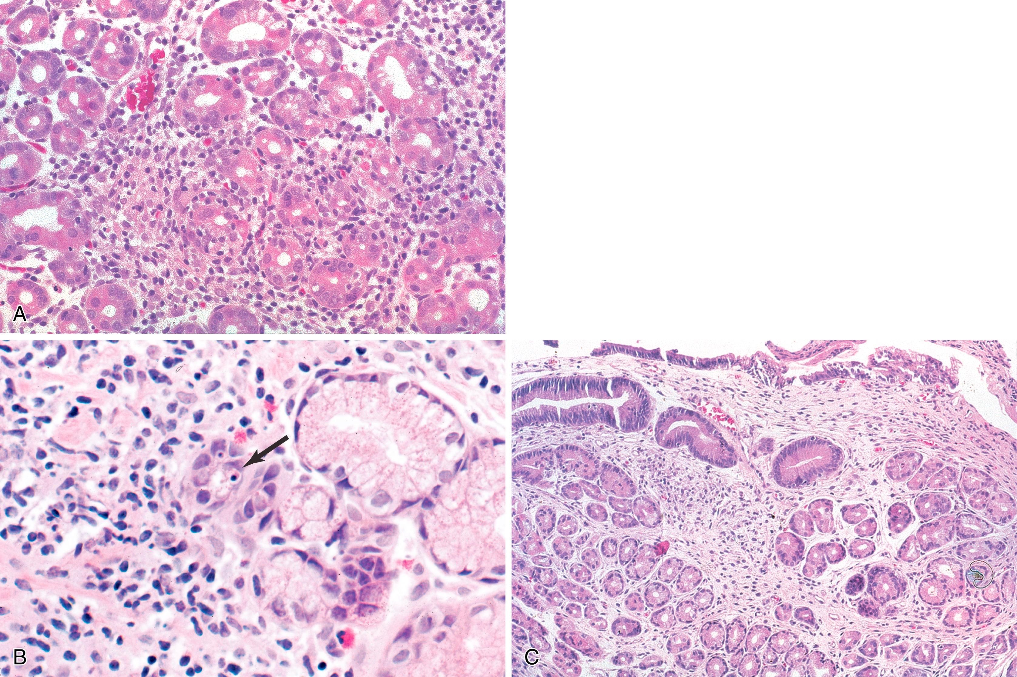 FIGURE 5.3, A, In common variable immunodeficiency (CVID), the gastric mucosa often contains a nonspecific mononuclear cell infiltrate. B, Notice the apoptotic body (arrow) and the absence of plasma cells. C, Loss of gastric glands leads to atrophic gastritis at a young age in patients with CVID. Loss of parietal cells results in pernicious anemia and may occur in the absence of antiparietal cell antibodies (H&E stain).