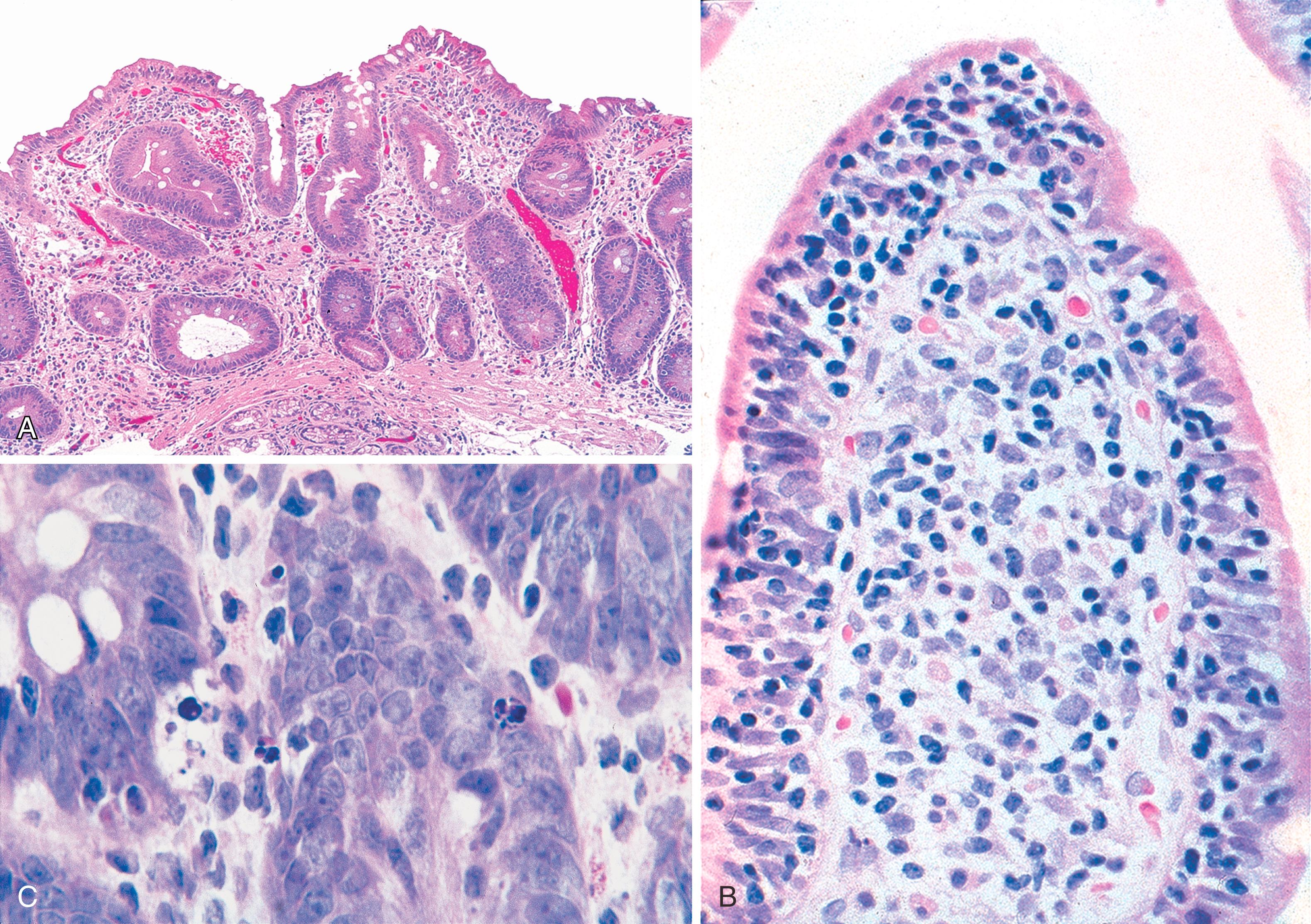 FIGURE 5.4, A, Villous atrophy associated with common variable immunodeficiency (CVID) may be severe and may lead to profound malabsorption. Notice the relatively sparse inflammatory infiltrate. B, The surface epithelium of the small intestine often contains a marked increase in the number of intraepithelial lymphocytes in CVID. C, An increase in crypt cell apoptosis is often found in small bowel biopsies with villous atrophy in CVID (H&E stain).