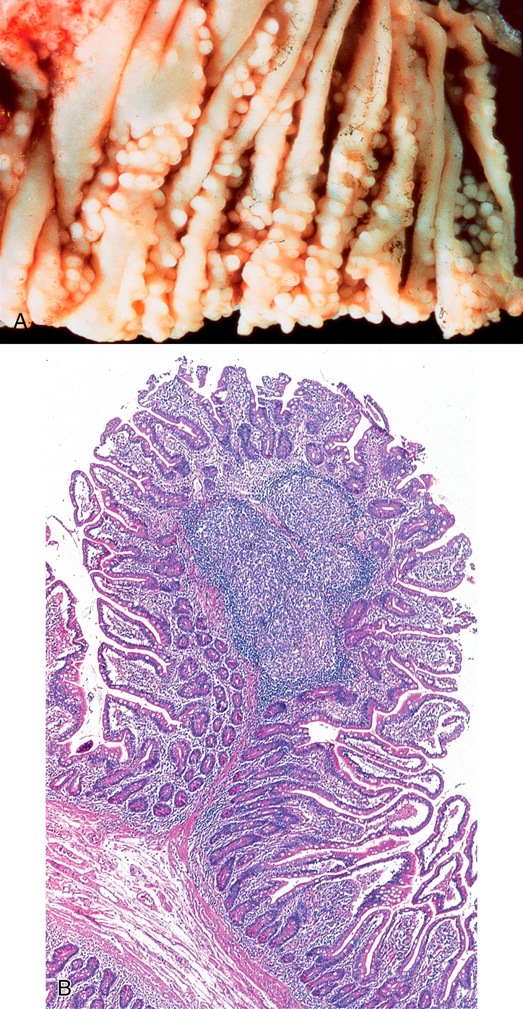 FIGURE 5.5, A, Nodular lymphoid hyperplasia in common variable immunodeficiency. Numerous small mucosal and submucosal nodules are present. B, Most of the lymphoid nodules contain enlarged germinal centers. Overlying villi are slightly distorted (H&E stain).
