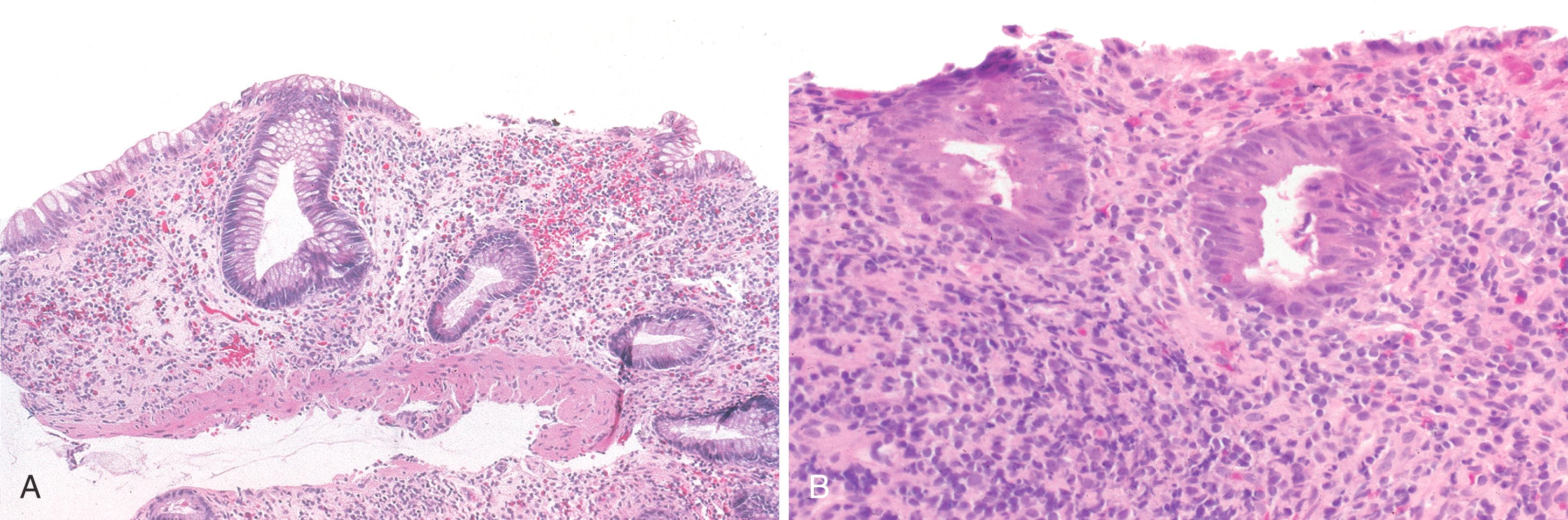 FIGURE 5.6, Colitis in common variable immunodeficiency may mimic inflammatory bowel disease, with crypt distortion and loss. A, The inflammatory infiltrate is relatively sparse in some cases, compared with ulcerative colitis, and plasma cells are not present. B, Notice crypt shortfall and infiltration of crypts by acute inflammatory cells (acute cryptitis).