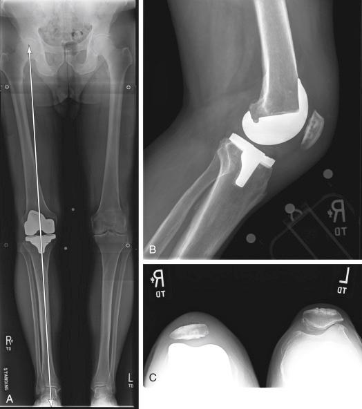 FIGURE 14.1, A, Hip-to-ankle radiograph demonstrates acceptable limb alignment (arrow) . B, Lateral radiograph shows appropriately positioned and sized components. C, Patellar view demonstrates a mild tilt but shows no evidence of overstuffing or malpositioning.