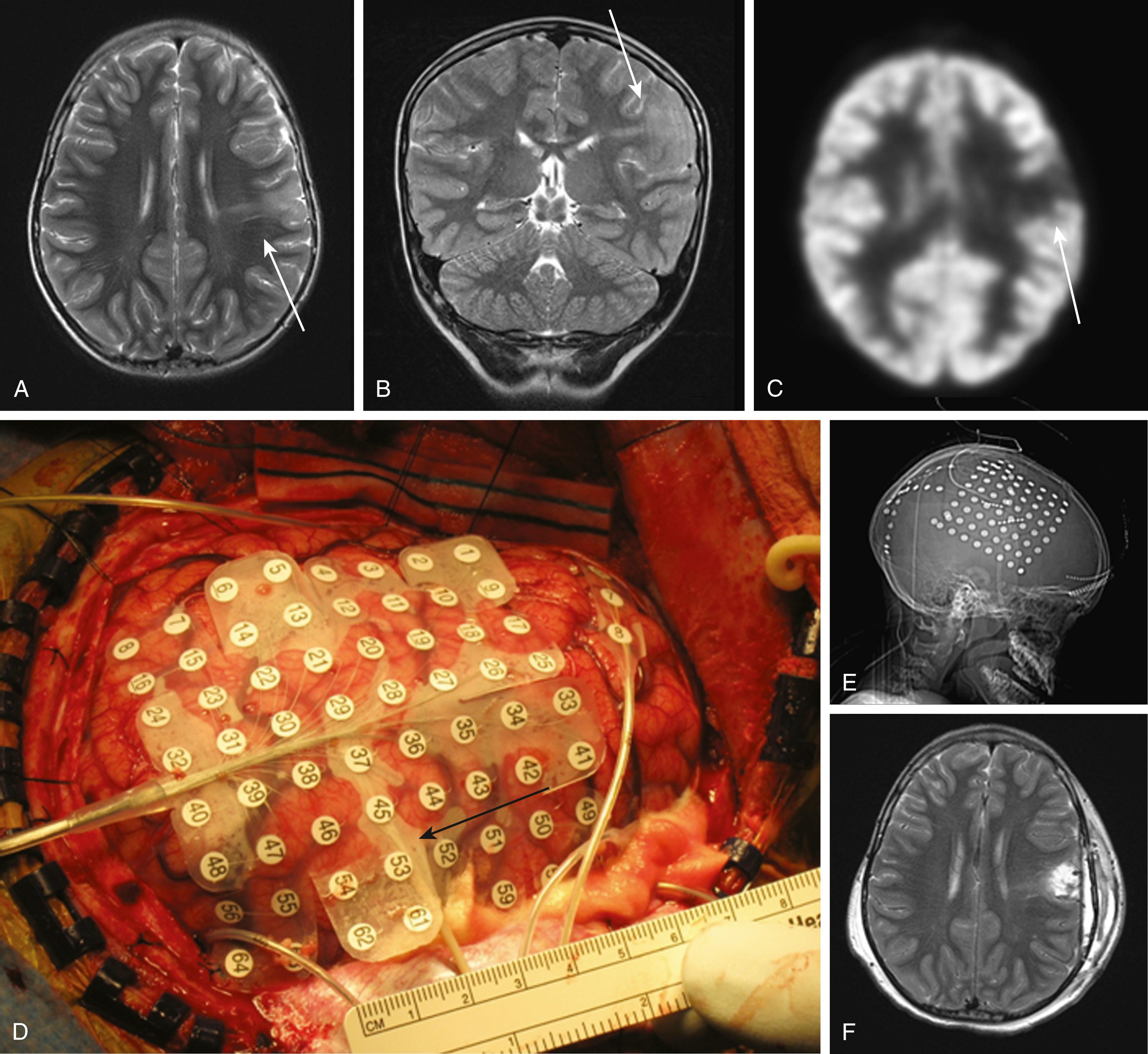 FIGURE 71.1, A 9-year-old boy with intractable epilepsy due to focal cortical dysplasia. Preoperative axial (A) and coronal (B) T2 magnetic resonance imaging (MRI) showed thickened cortex in the parietal lobe with a tail of dysplasia extending to the ventricle (arrows) . (C) Positron emission tomography showed corresponding hypometabolism (arrow) in dysplastic focus. (D) Grids, strips, and depth electrodes were implanted to more precisely localize seizure onset and map motor and language functions. Arrow shows insertion site of depth electrode under grid. (E) X-ray of final electrode arrangement. All recorded seizures began superficially in the dysplastic area. Language and motor function were sufficiently removed to allow for a focused, superficial resection of the dysplasia as shown by the postoperative MRI. (F) Representative axial T2 image.